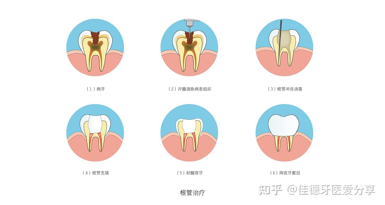 只能做根管治療的時候,費錢費事還疼~但若你忽視蛀牙,等它齲壞發展