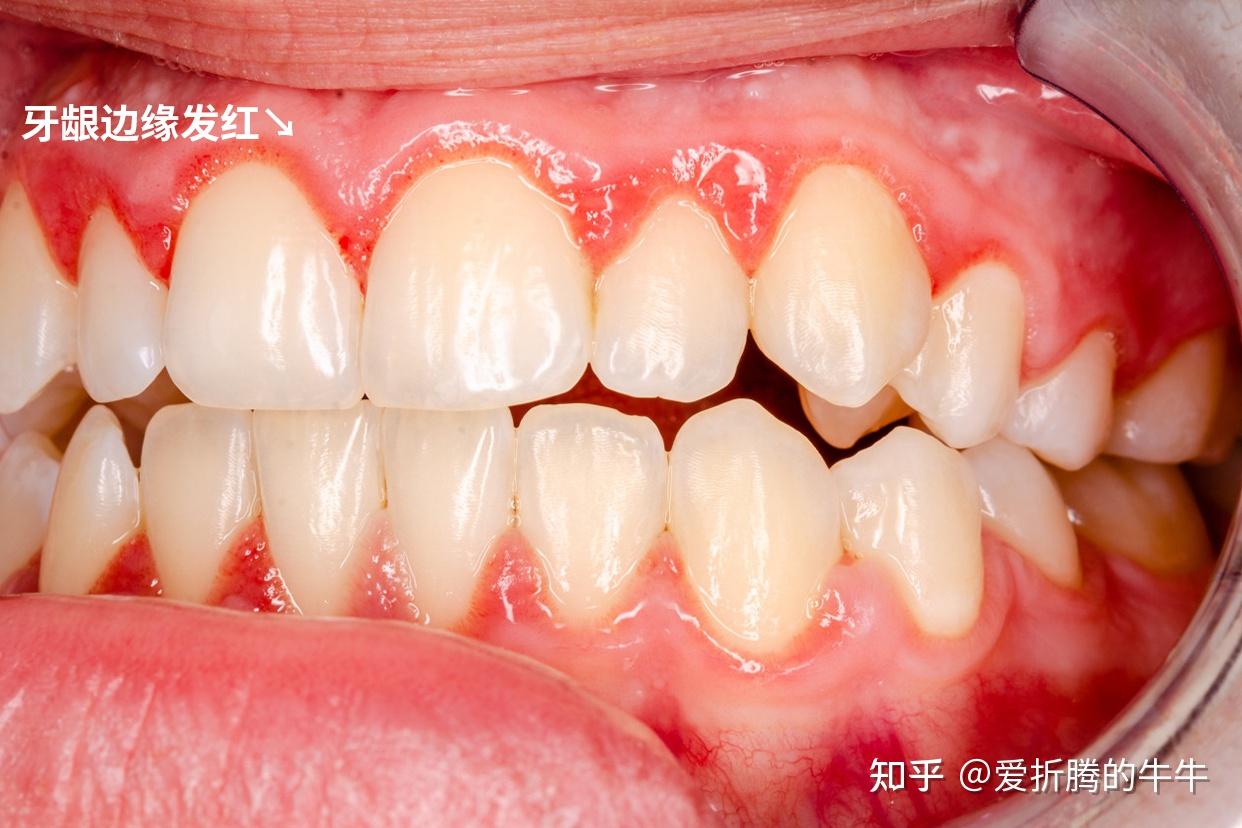 主要原因,其表現為牙齦與牙齒交界處發紅,以及牙齦邊緣輕微腫脹和出血