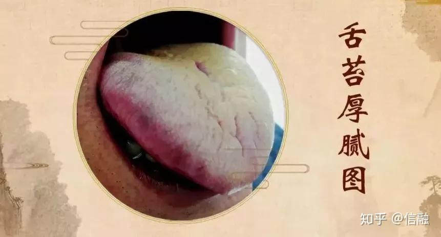 平素舌体胖大,舌苔白腻或甜;眼胞微浮,容易困倦;多汗且粘,胸闷,痰多