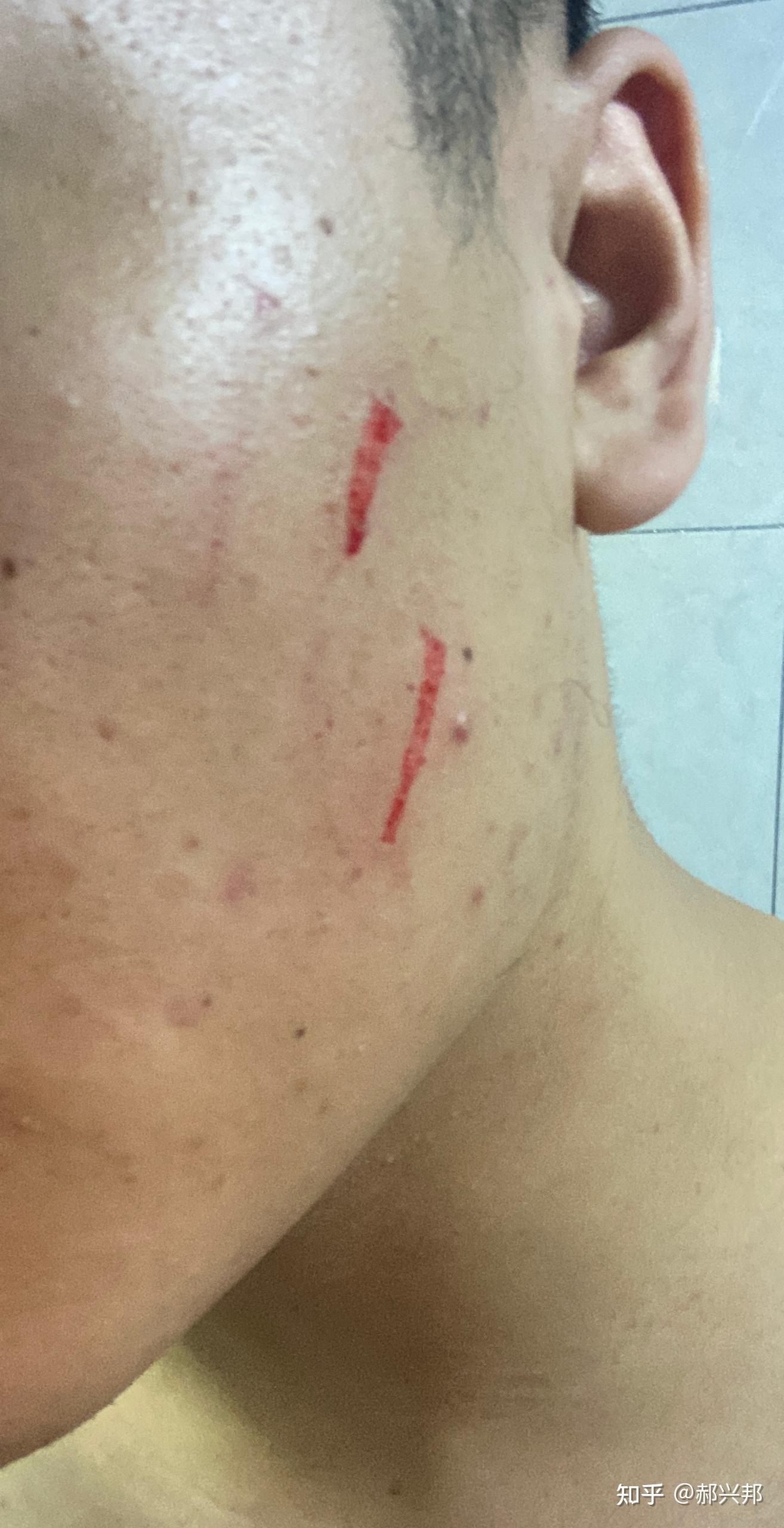 脸部被被抓伤,会留下疤嘛?