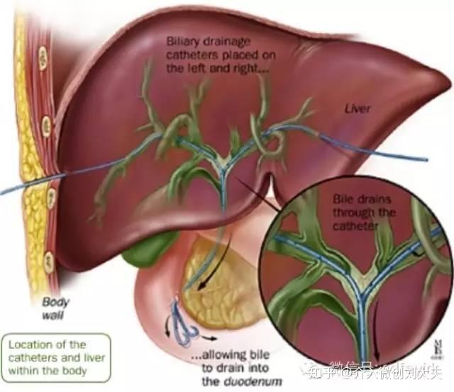 扫黄行动梗阻性黄疸的介入微创治疗