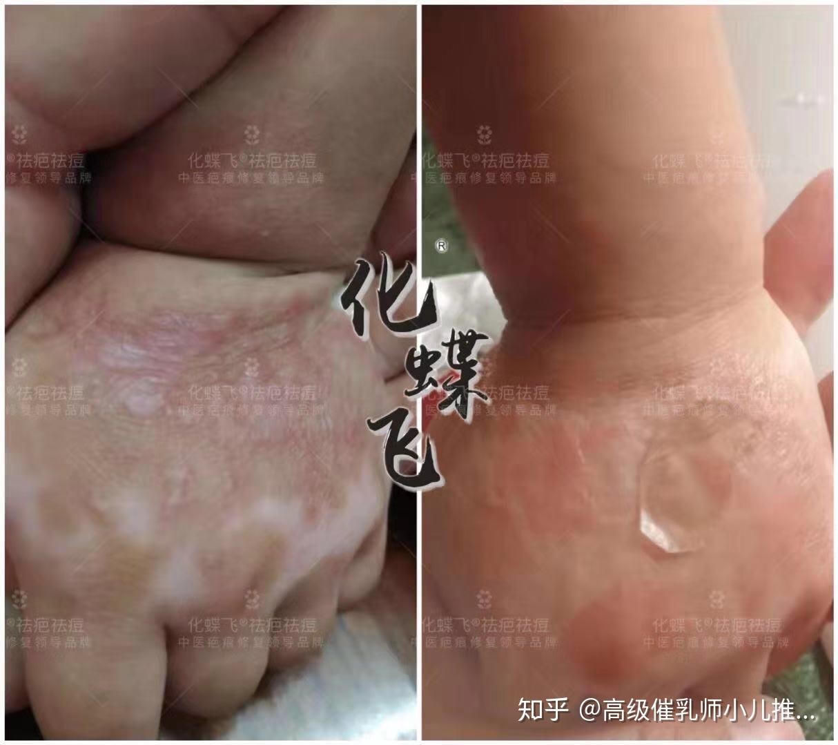 使用中藥塗抹修復,疤痕平復了85%以上,讓人驚喜的是色脫竟然都恢復了