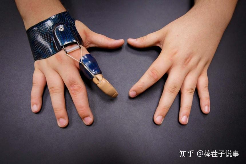 手指和部分手缺失的假肢安装方案