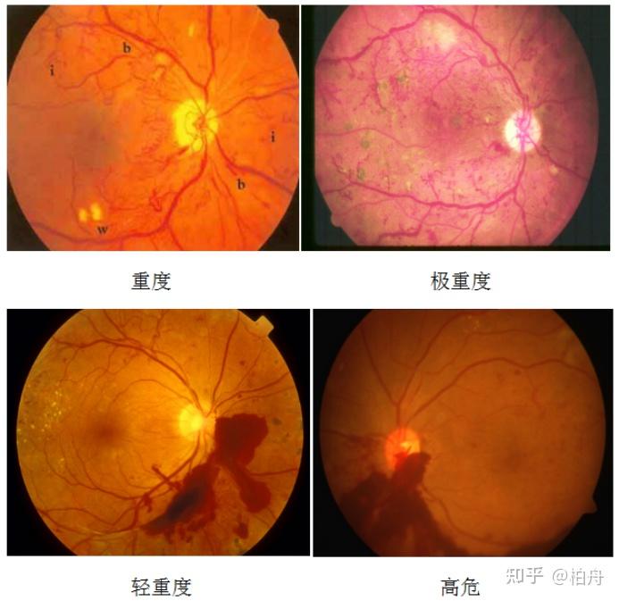 眼部年轻化的最佳方案_眼部年轻化是什么意思_眼部年轻化