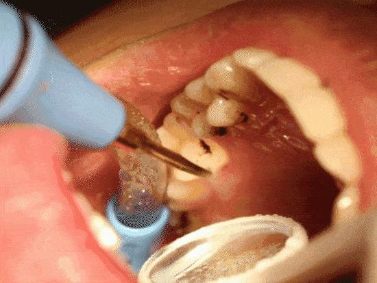 第一招:分解 清除,牙齿变白