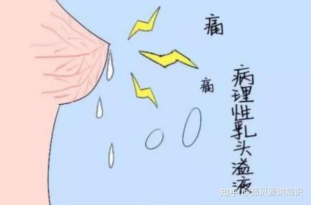 乳腺增生的症狀是什麼乳腺增生的症狀與治療