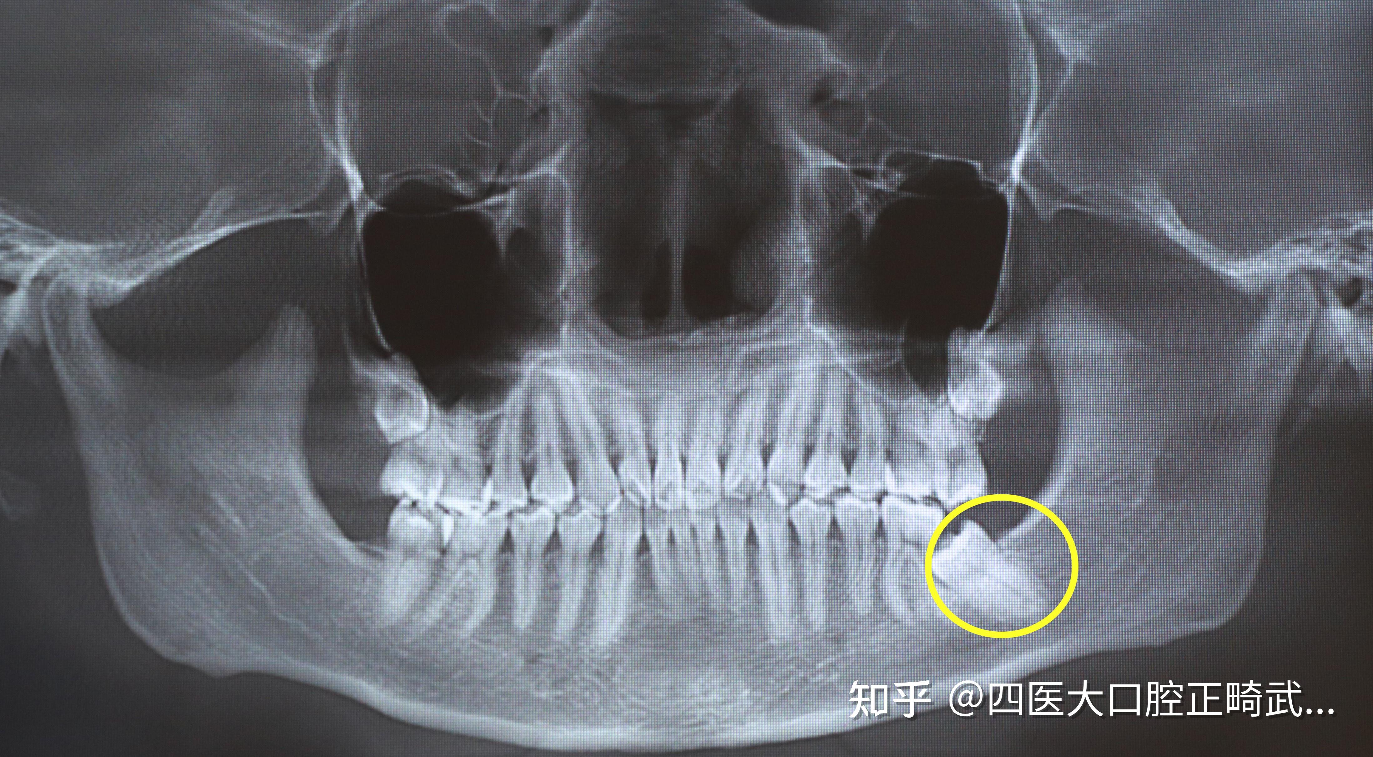 上海牙齿矫正：舌侧矫正地包天，片切挂三类牵引改善月牙面型 - 知乎