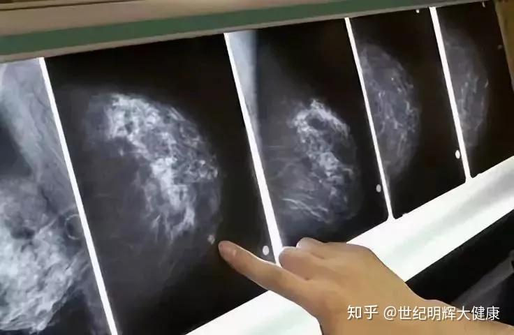 乳腺鉬靶x線no.