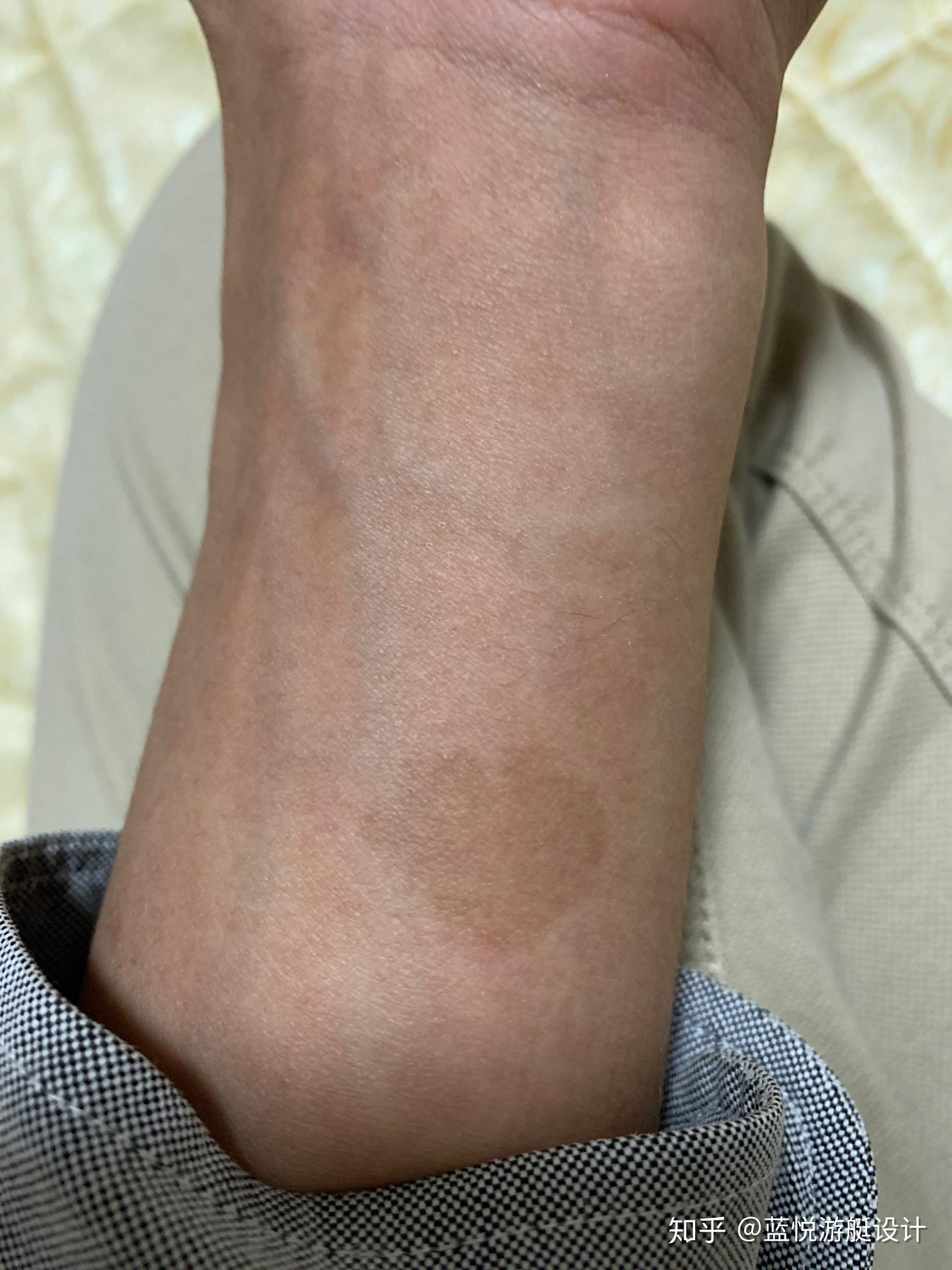 请问还有手腕处是爱心胎记的人吗