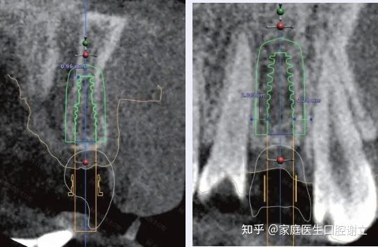 種植體的軸向設計:偏顎側植入,穿出點位於舌隆突,整體軸向是切端偏舌