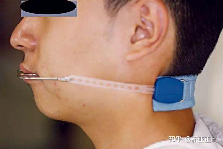 学术正畸|不拔牙矫治程序及注意事项 - 知乎