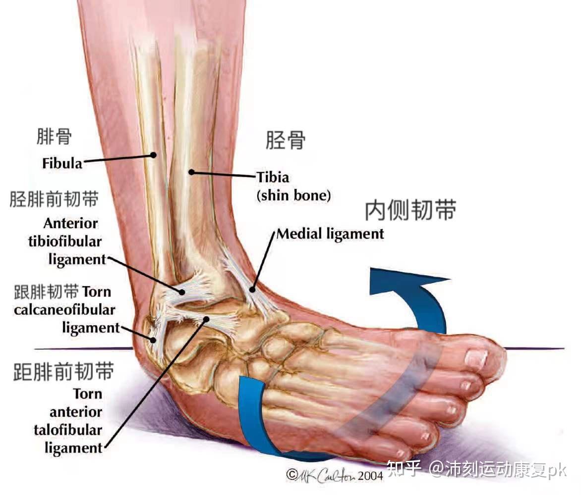 踝关节韧带如果内侧副韧带损伤,将出现踝关节侧方不稳定,若外侧副韧带