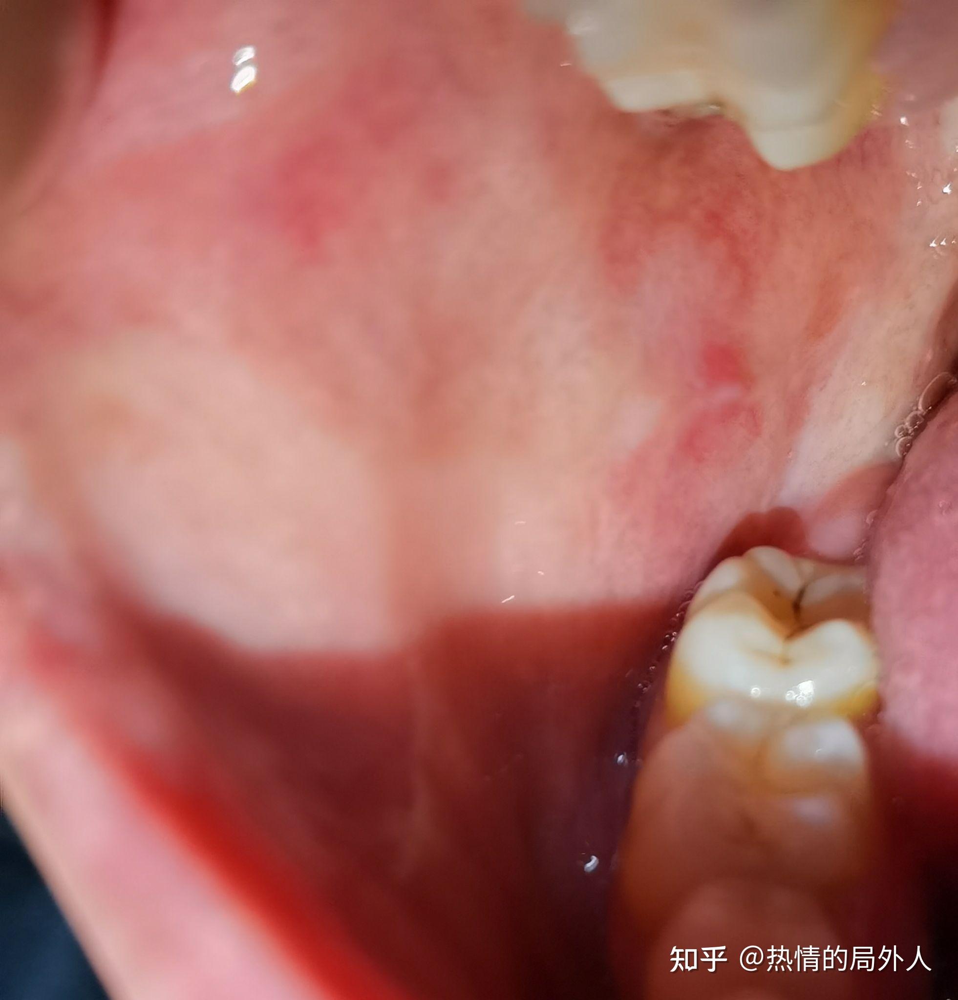 口腔扁平苔藓症状图片图片