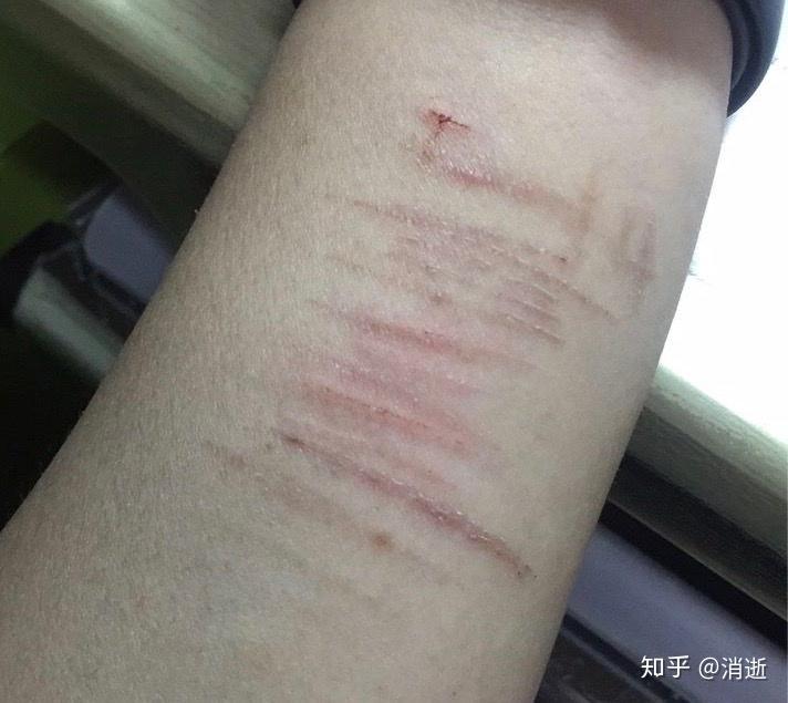 有过自残,小臂上的疤终于在今年军训之前淡化了,否则我真的不知道该