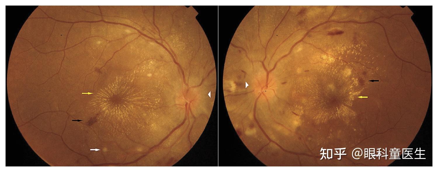 与系统性疾病相关的视网膜病变3妊高症的眼底改变