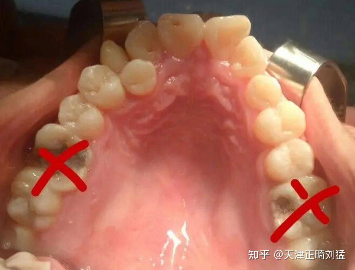 牙齿上的黑线究竟是什么？__中国医疗
