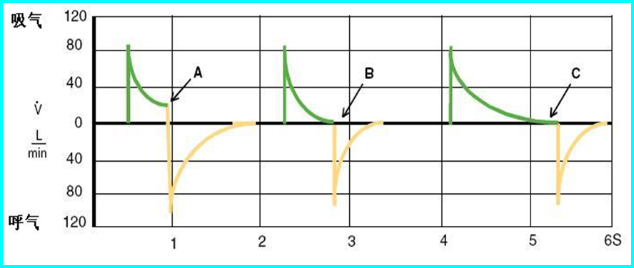 呼吸机常见波形