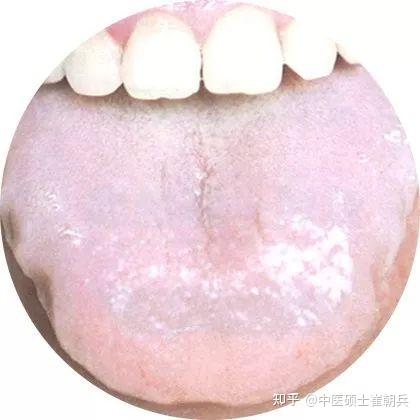 史上最全高清舌诊图谱,堪比教科书(收藏篇) - 知乎