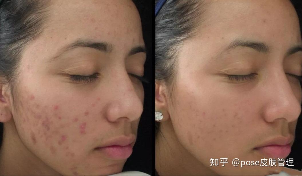 【超全解析】刷酸后,爆痘,变敏感到底正不正常? - 知乎