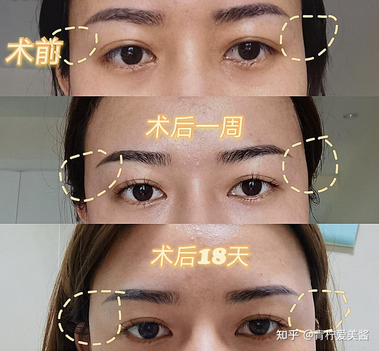 面部填充脂肪存活率_自体脂肪面部填充维持_面部填充自体脂肪