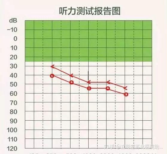 听力图的解读 - 知乎