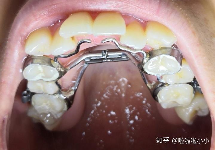 扩弓本人是医学奇迹正颌术前正畸