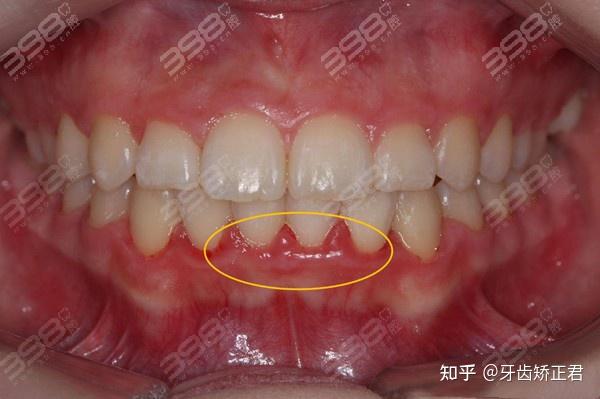 再来看看那牙龈长脓包的原因