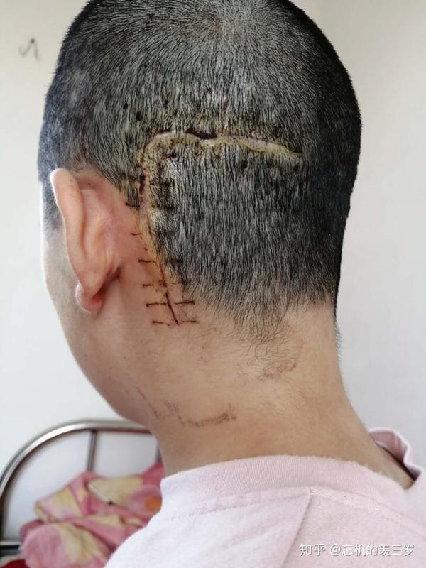 听神经瘤术后分享