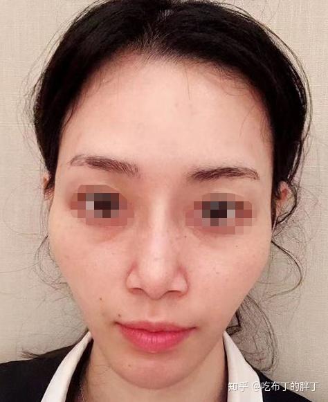 苹果肌扁平,太阳穴凹陷,泪沟明显怎么办?