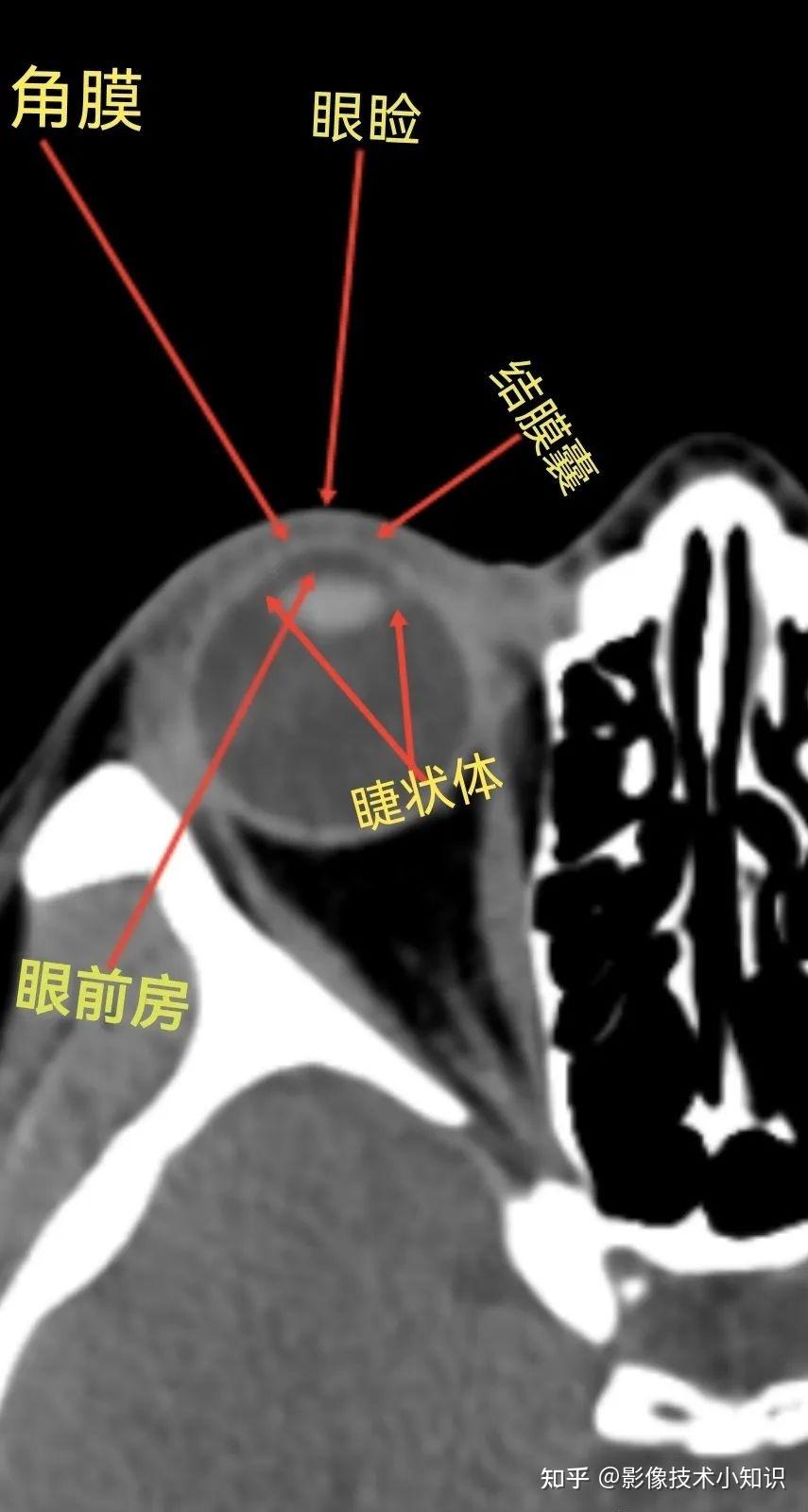眼的CT解剖 - 知乎