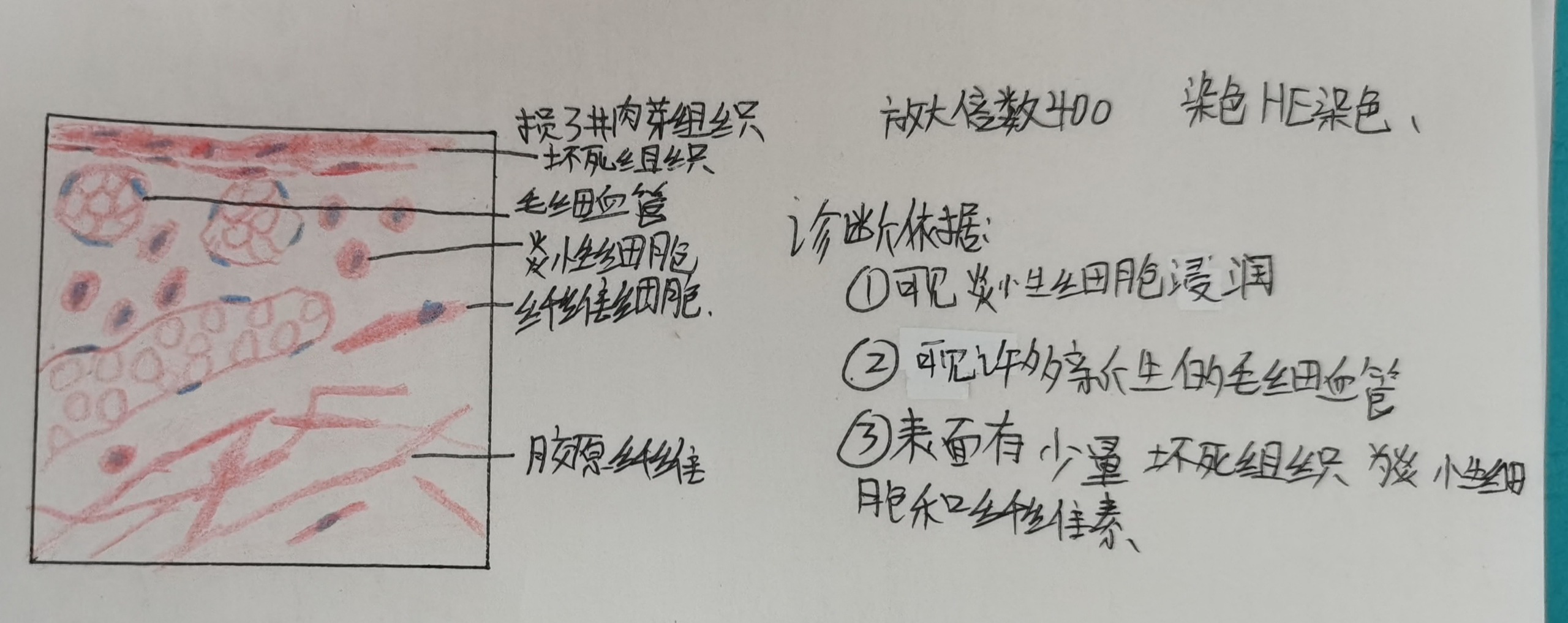 結締組織透明變性,肉芽組織,腎小管上皮細胞顆粒變性(腎水腫)鏡下紅藍