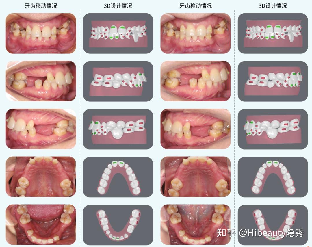 每周案例：固定矫治器局部矫正扩展种牙间隙 - 知乎