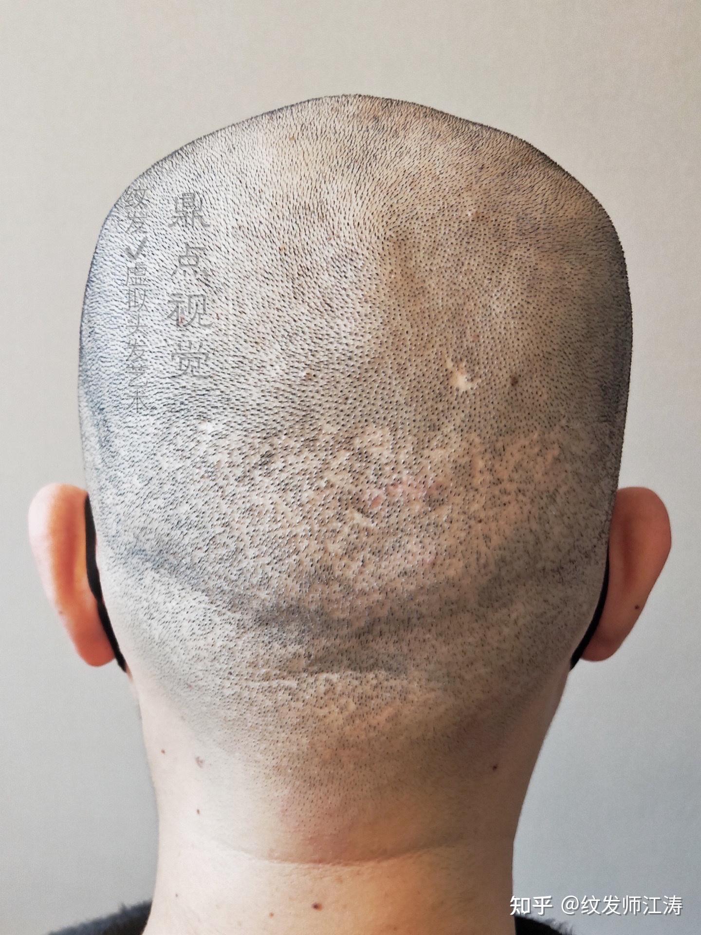 fue无痕植发到底会不会留下疤痕