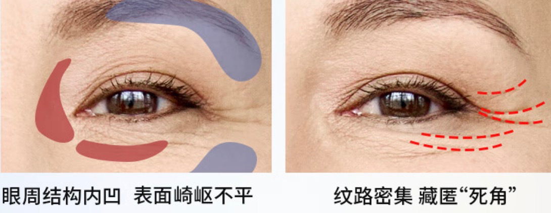 三,眼周美眼仪怎么选?