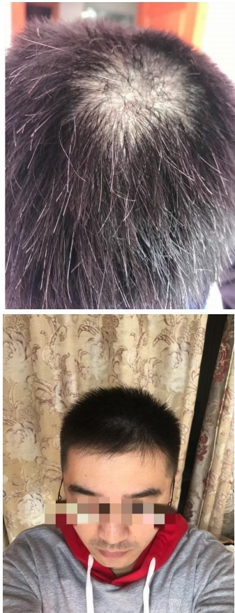 全球大揭秘少白头,秃发,斑秃的原由及治疗指南 - 知乎