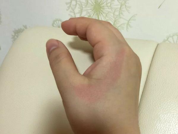 烫伤留的疤痕红印怎么淡化?这凝胶效果绝绝子