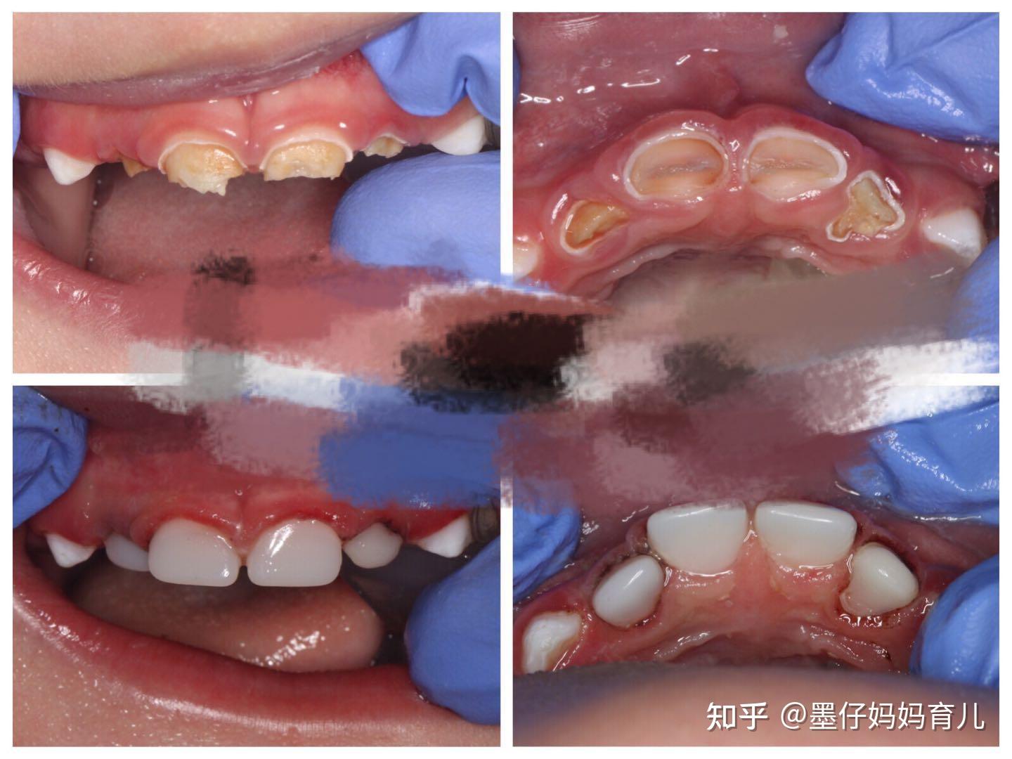 婴儿牙釉质损伤图片图片