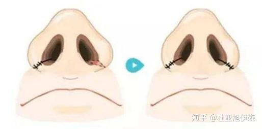 什么办法能让鼻翼缩小 v2-f37d225fe6190535189d6fc870ccd94a_r.jpg