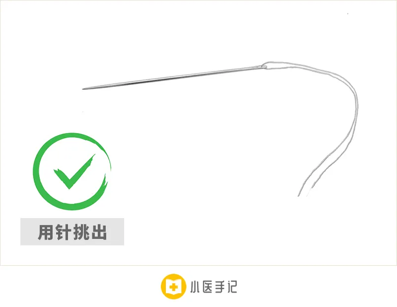 一分钟处理皮肤扎刺 - 知乎
