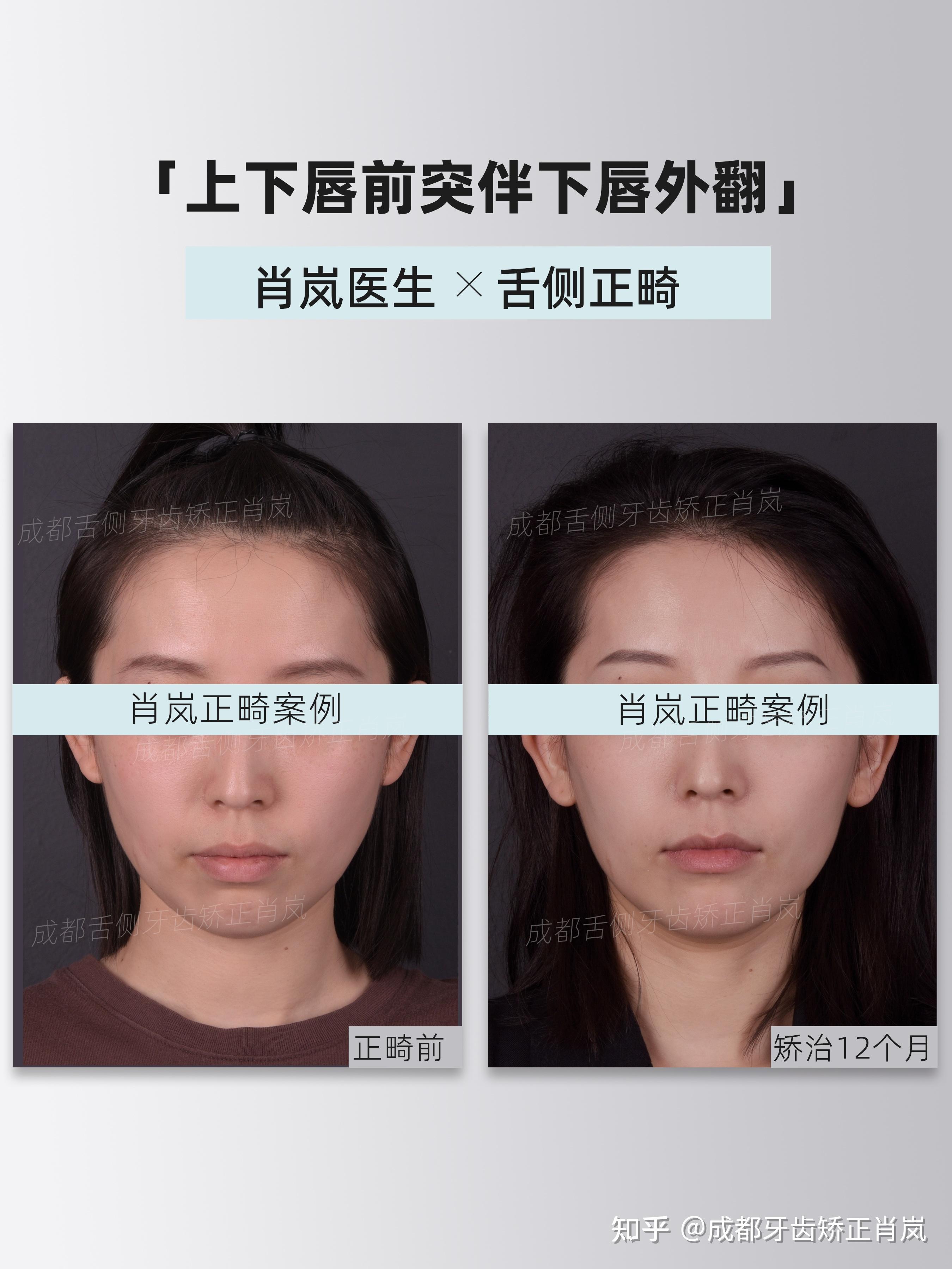 成都牙齿矫正|舌侧正畸|隐形矫治12个月侧貌改善 - 知乎