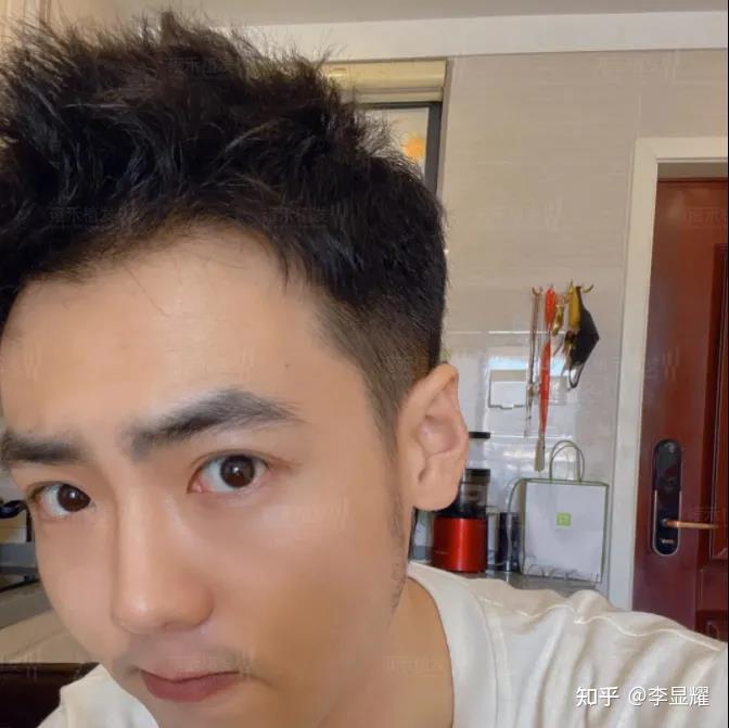 植发9个月,小泽的帅气难以抵挡