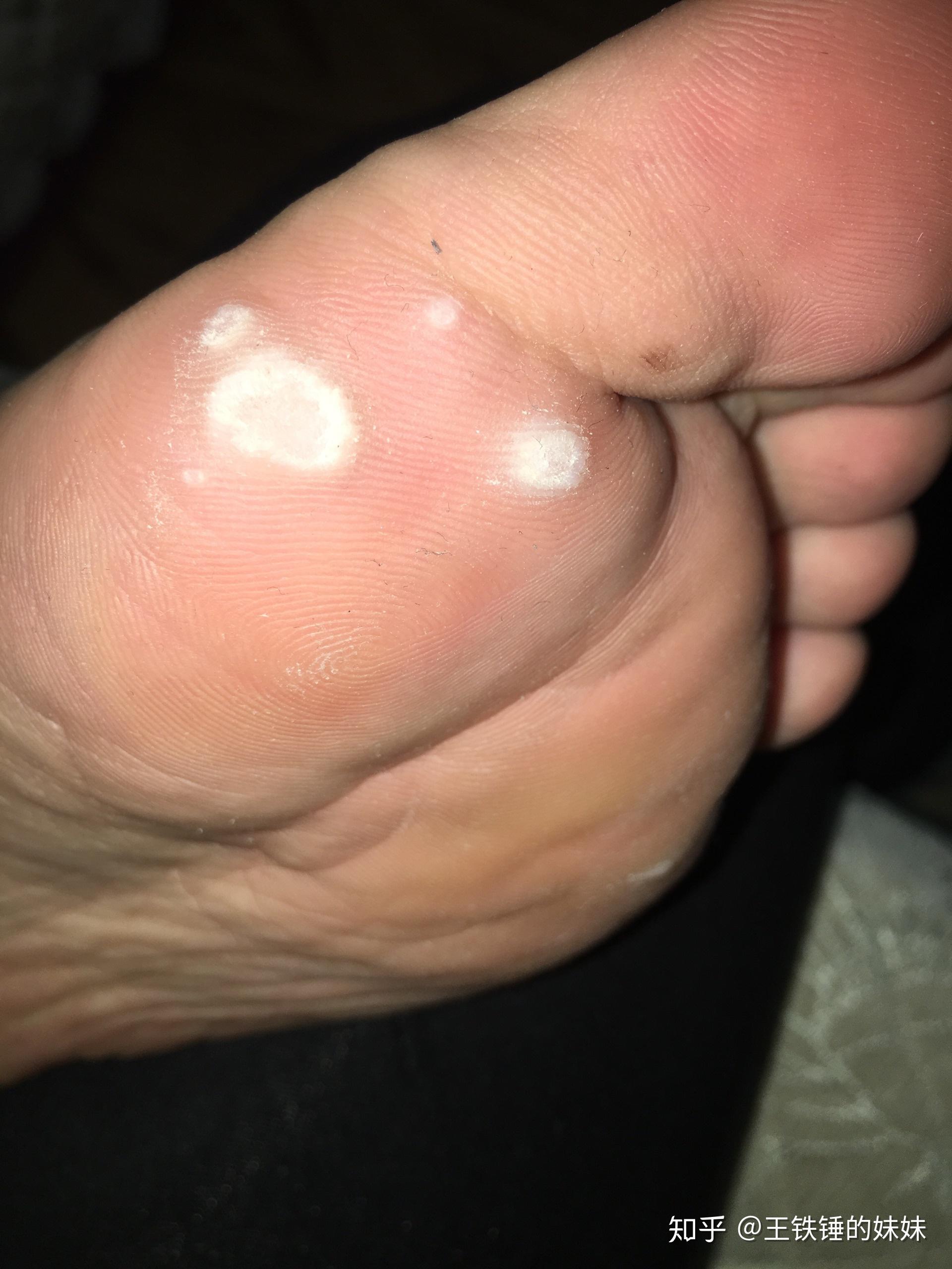 跟跖疣足疣战斗三年