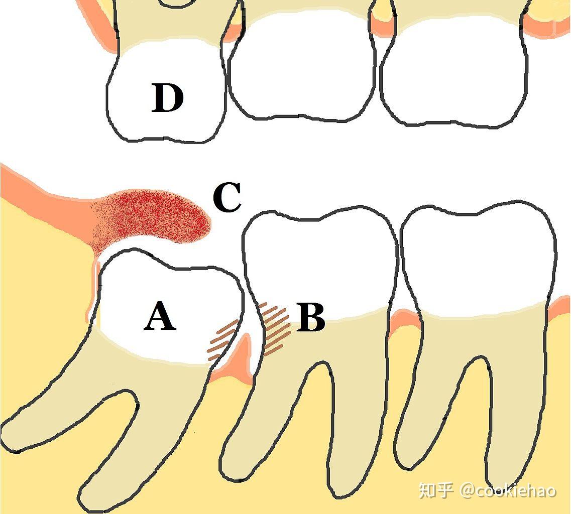 槽牙位置图图片