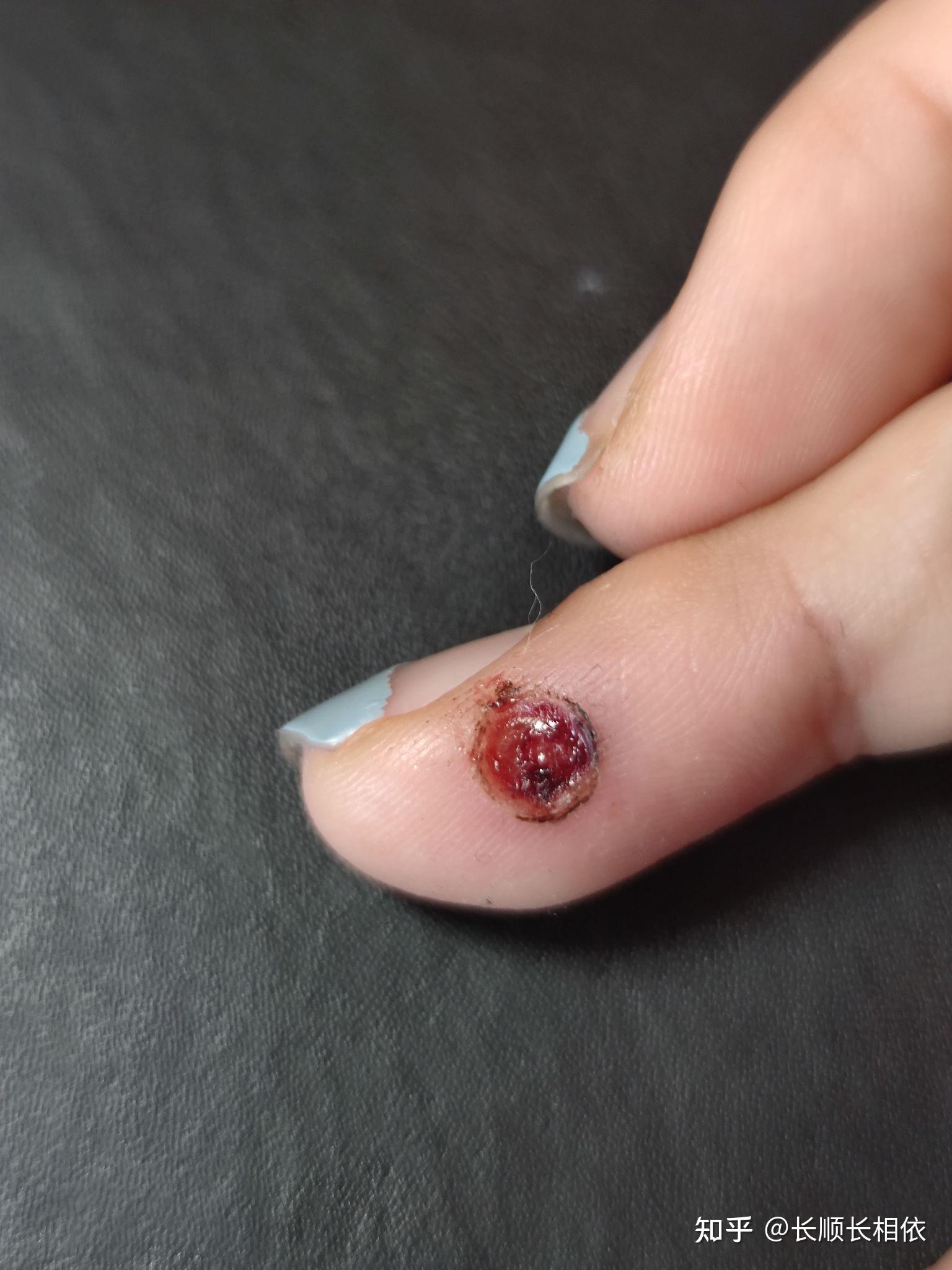激光去除手指病毒疣记录 复发 - 知乎