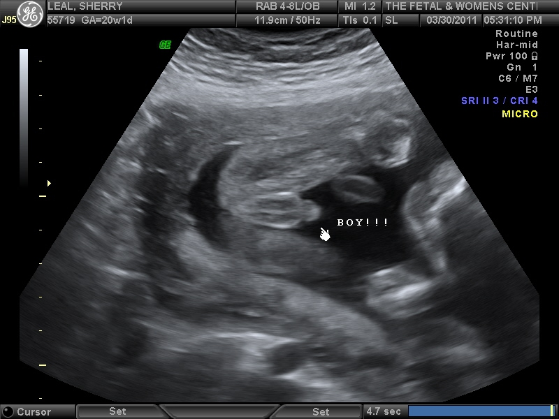 胎儿生殖系统超声图片图片