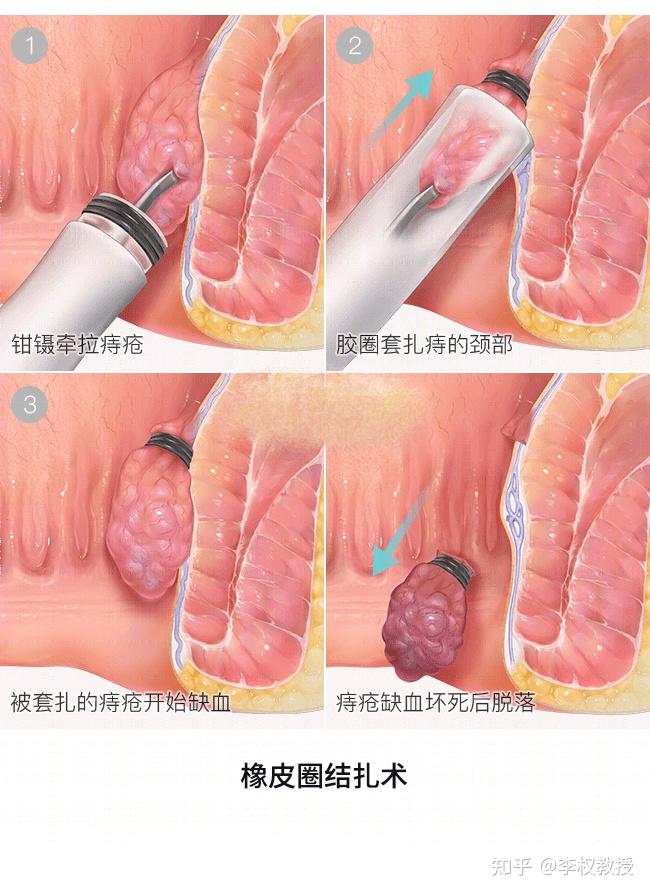 胶圈套扎痔疮疗法图片