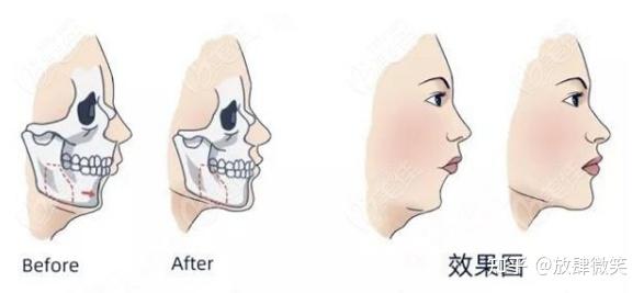 下颌后缩(下巴后缩)应该做正颌还是颏成型 - 知乎