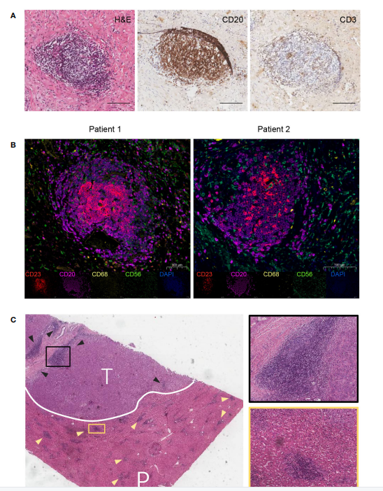 三级淋巴结构在肿瘤微环境中的作用 - 知乎