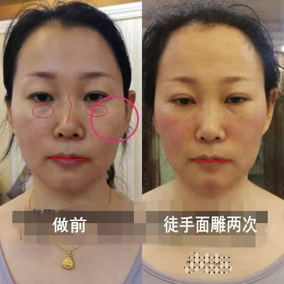 二,非创伤性徒手整形整容