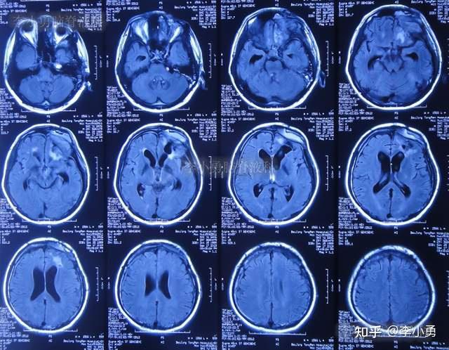 腦外傷後腦脊液鼻漏顱內動脈瘤栓塞術後和開顱術腦脊